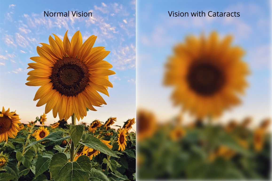 Normal Vision vs Cataract Vision