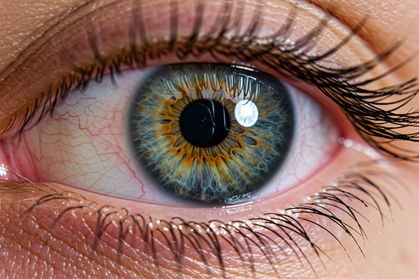 Corneal Ulcer