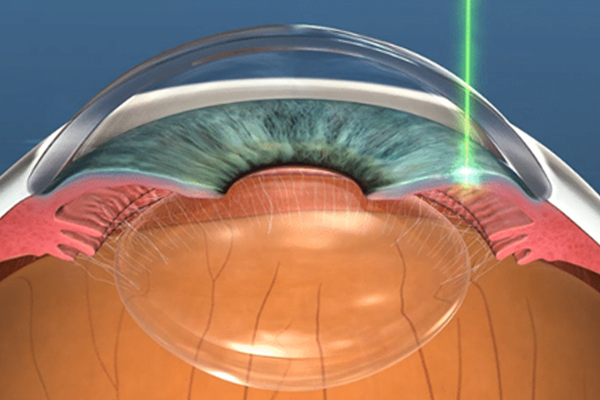 Laser PI