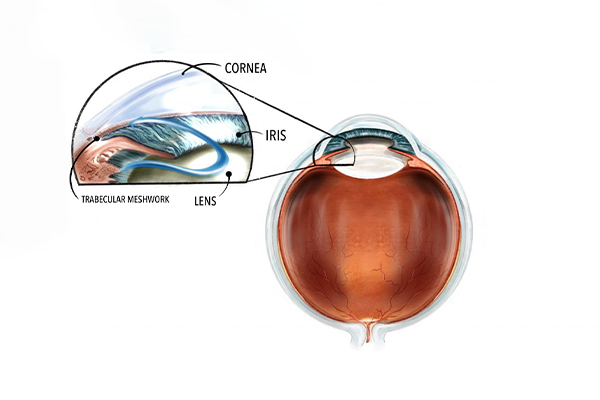 Trabeculectomy Surgery