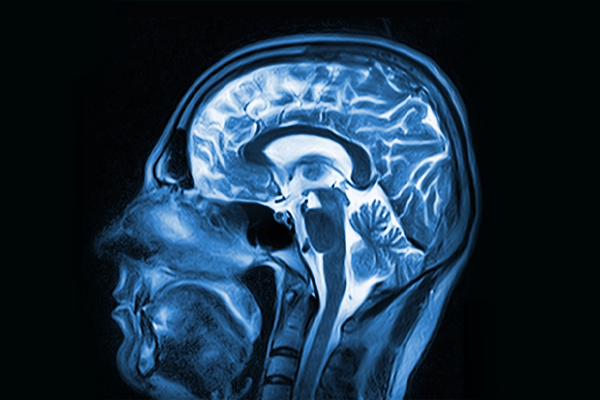 Neuroimaging