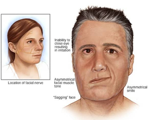 Cranial Nerve Palsy Case