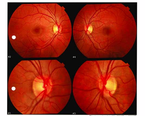 Optic Neuritis Case