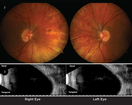 Visual Field Defect Case