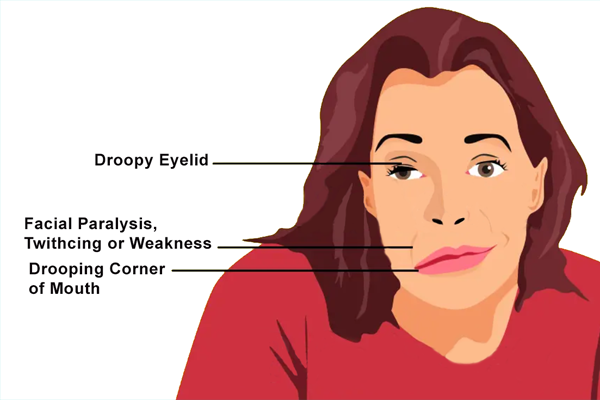 Cranial Nerve Palsies