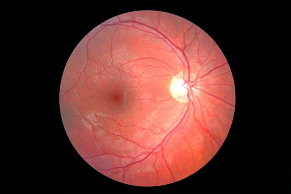 Optic Nerve Imaging