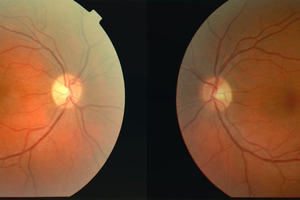 Optic Neuritis