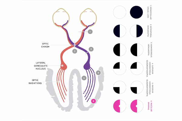 Visual Field Defects