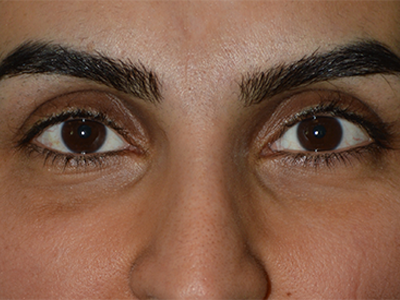 After Orbital Fracture Repair