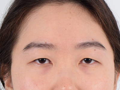 Before Ptosis Correction