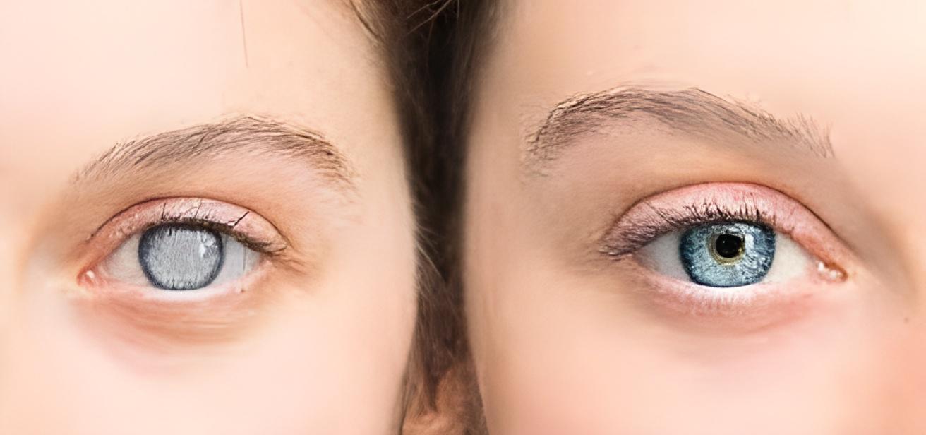 Cataract Surgery Results