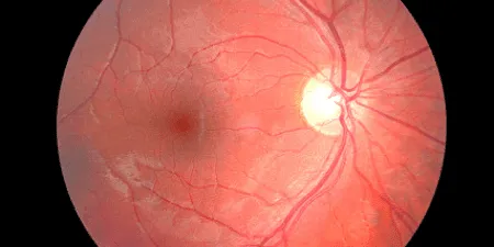 Retina Services