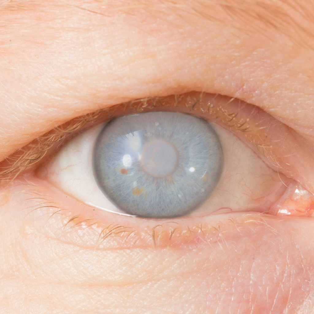 Cataract Surgery Services
