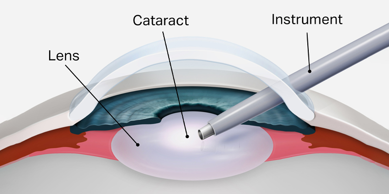 Cataract Surgery Procedure