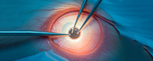 Removing the Lenticule
