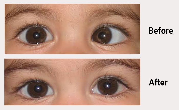 Squint Treatment