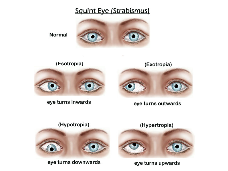 Amblyopia Treatment